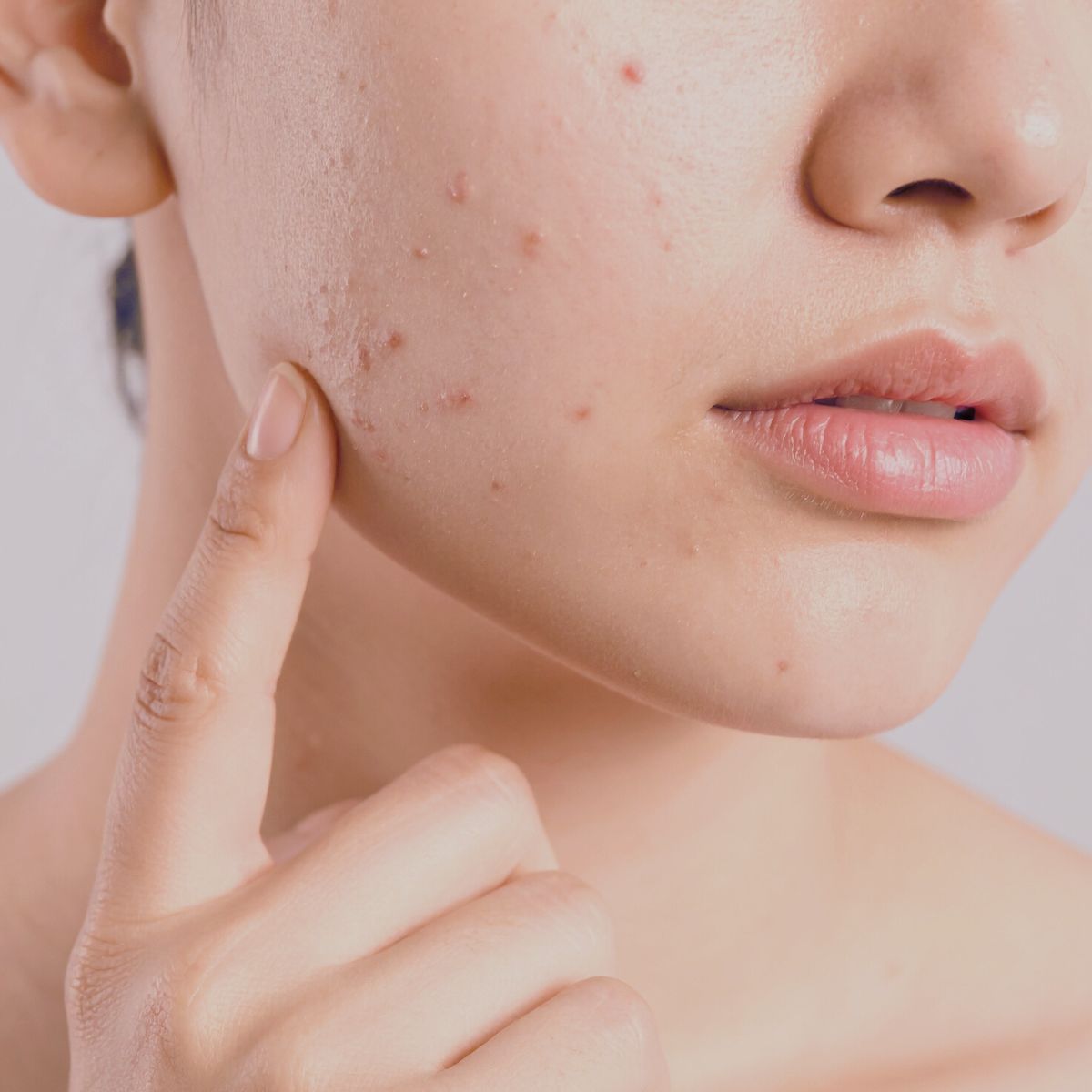 Breakouts & Blemishes