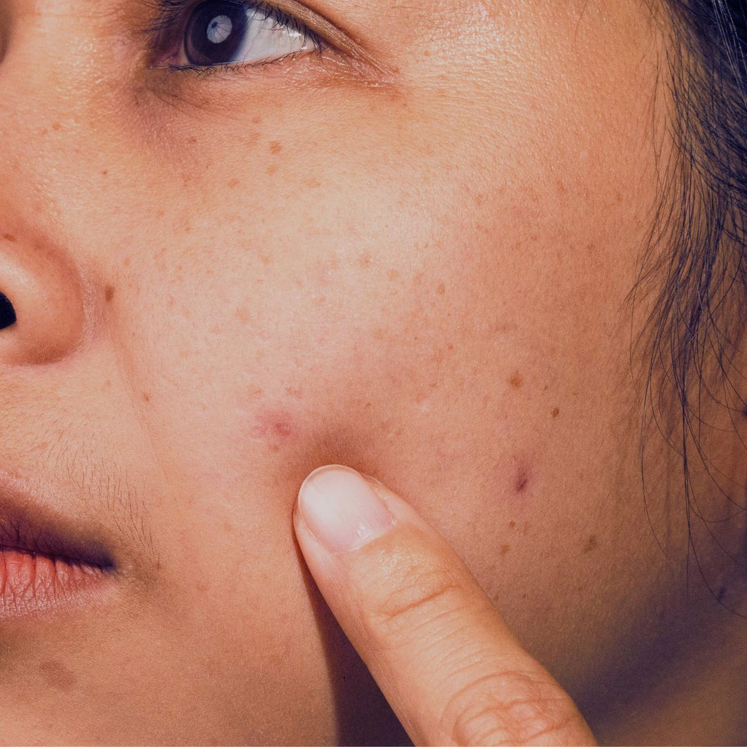 dullness-and-uneven-tone-thumbnail-soul-apothecary