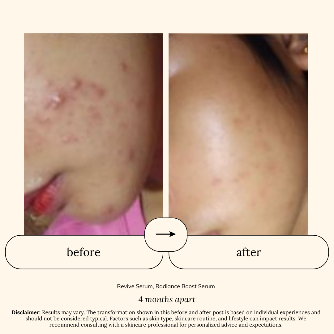 Bestseller Sets for Dry, Acne-Prone Skin