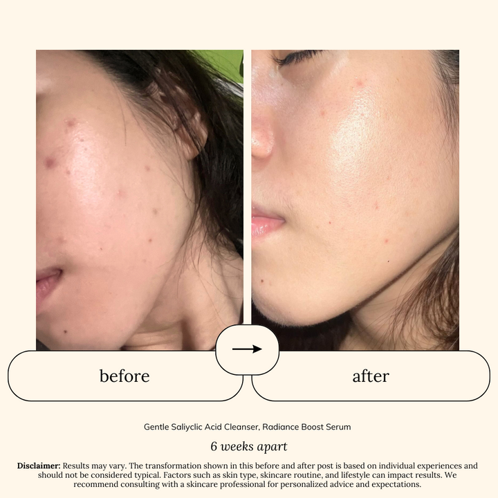 Bestseller Sets for Oily or Combination, Acne-Prone Skin