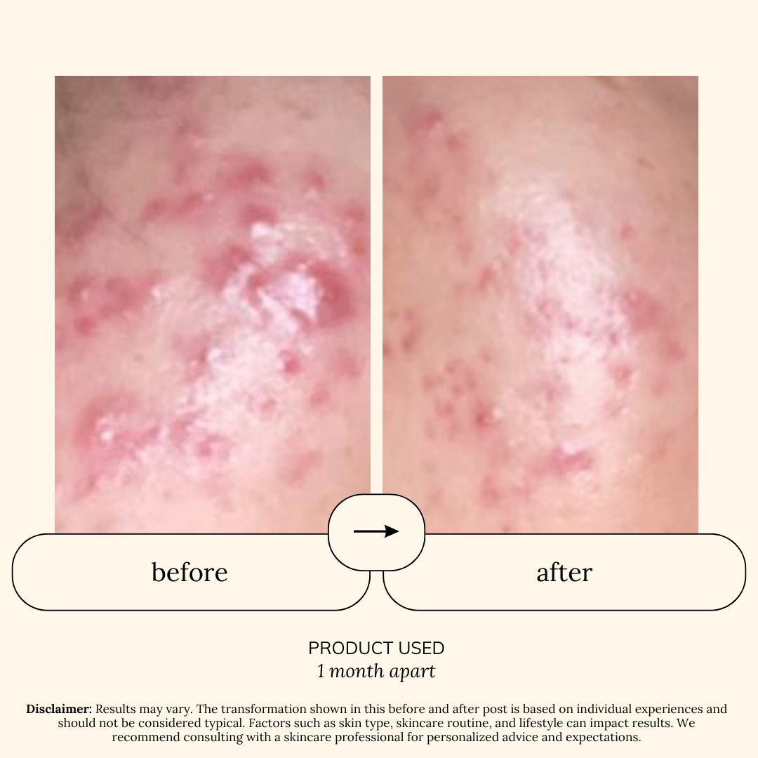 Hydra Gentle Spot Care