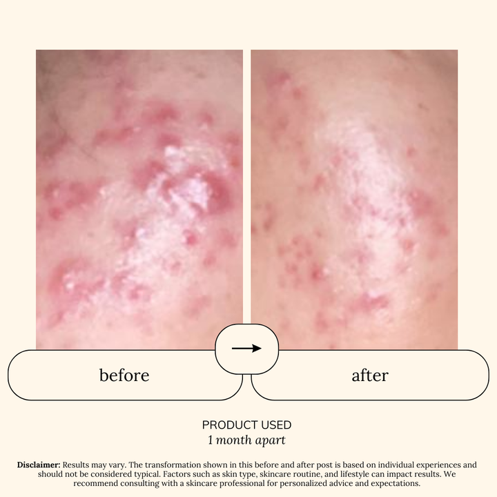 Hydra Gentle Spot Care